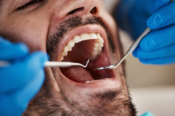 Best Broken or Chipped Tooth Repair in Fulton, MS